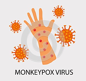 Monkeypox virus zoonotic viral disease that can infect human, nonhuman primates. Monkey pox. Vector illustration