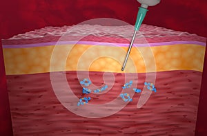 Monoclonal antibody treatment (Adalimumab) - isometric view 3d illustration