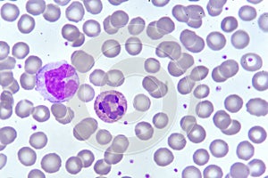 Monocyte and neutrophil cell in blood smear