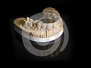 Monolithic zirconia restorations implant supported with the cer