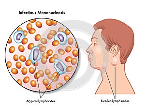 mononucleosis photo