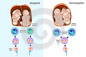 Monozygotic or dizygotic twins.