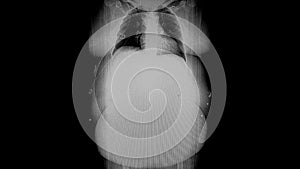 Morbidly obese person - alternating lateral and frontal x-rays