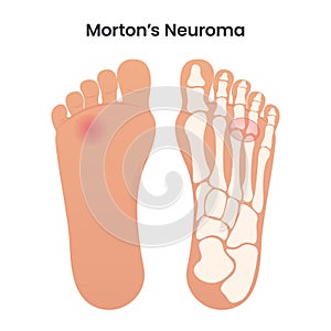 Morton\'s Neuroma medical educational vector illustration graphic