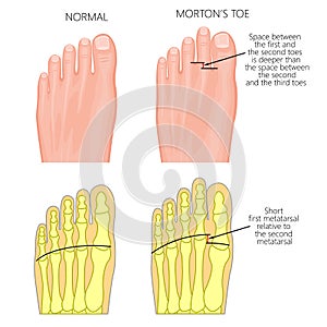 Morton`s toe photo