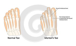 Morton's toe vector illustration
