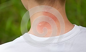 Mosquito bites. Girl with blond hair, sitting with his back to turn. Close-up of visible red, swollen neck skin from mosquito bite