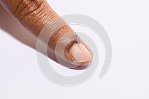 Mosquito Bites Human Finger