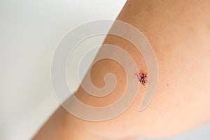 Mosquito death on woman arm. After hit by her palm.