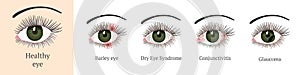 Most common eye problems