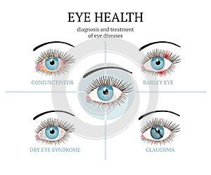 Most common eye problems - conjunctivitis, glaucoma, dry eye syndrome, barley eyes.