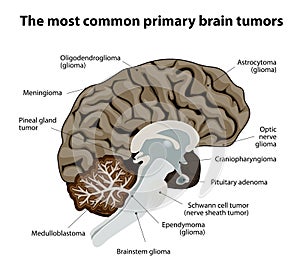 La maggioranza comune primario cervello 