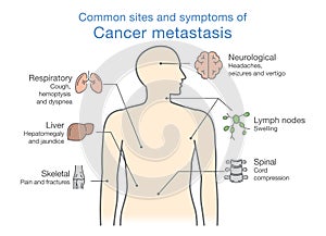 Most common sites and symptoms of Cancer Metastasis. photo