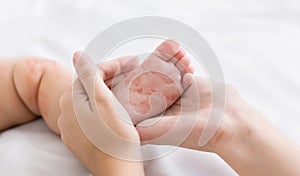 Mother holding tiny baby foot with measles rash