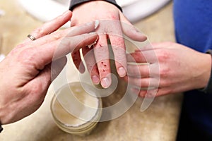 Mother Putting Lotion on the Hands of Child with Severely Dry and Cracked Skin