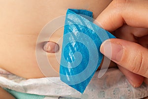 Mother& x27;s hands seal the umbilical hernia of a newborn child with a blue plaster. Treatment of an enlarged umbilical