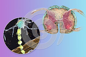 Motor neuron diseases, 3D illustration