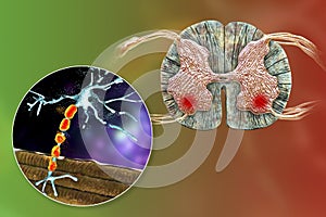 Motor neuron diseases, 3D illustration photo