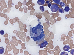 Mott cell in bone marrow.