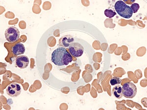 Mott cell in multiple myeloma. photo