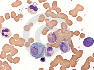 Mott cell in multiple myeloma. photo