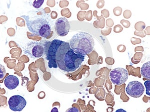 Multiple myeloma with foamy Mott cell. photo