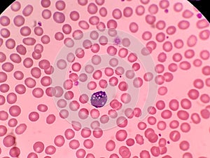 Mott cell - Plasmocyte. Blood smear. Red blood cells
