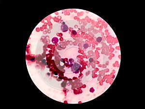 Mott Cell - Plasmocyte - Bone marrow. Hematology. photo