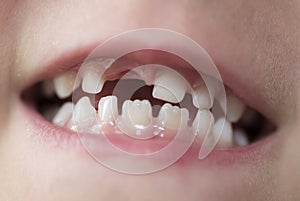 Mouth of a boy with missing tooth.