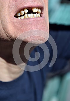 mouth missing front tooth awaiting implant in senior male citizen