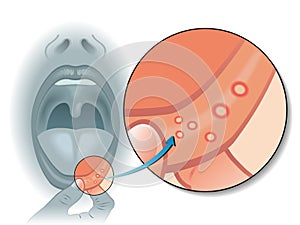 Mouth sores photo