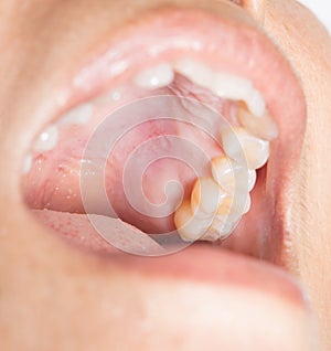 Blisters in the mouth. Infection photo