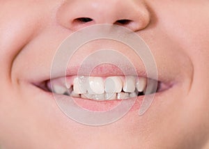 Mouth with white teeth