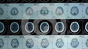 Moving skull brain X-ray,head pet cT scan.