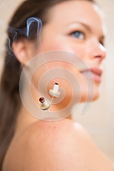 Moxibustion acupunture needles heat on woman
