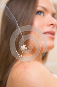 Moxibustion acupunture needles heat on woman