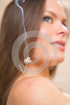 Moxibustion acupunture needles heat on woman