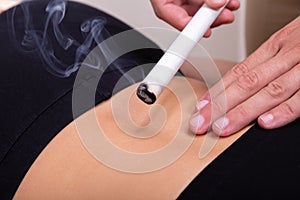 Moxibustion Procedure At Health Center