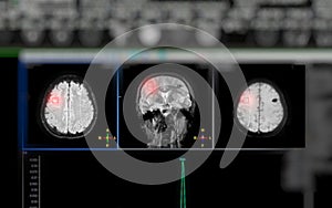 Pan v mrtvice nemoci pokud chemický analýza na pochopit změny v ovlivněna mozek 