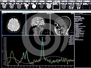 MR spectroscopy aids in stroke diseases, providing insightful chemical analysis to understand metabolic changes in affected brain