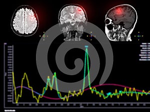 MR spectroscopy aids in stroke diseases, providing insightful chemical analysis to understand metabolic changes in affected brain