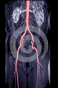 MRA Abdominal aorta with Abdominal aorta photo