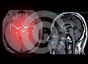 MRA Brain  axial MIP view showing cerebral artery