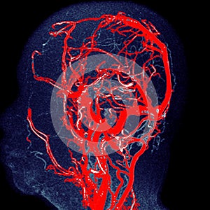 MRA brain Coronal 3D Sagittal MIP view showing Common carotid artery and cerebral artery