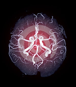 MRA Brain or Magnetic resonance angiography of the brain.
