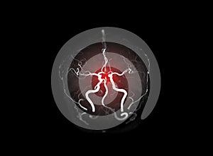 MRA brain or Magnetic resonance angiography image  MRA  of cerebral artery in the brain.