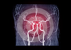 MRA Brain or Magnetic resonance angiography MRA of cerebral artery.