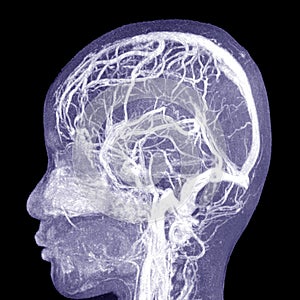 MRA BRAIN.Moderate perilesional vasogenic edema with 0.7 cm midline shift to the left side.Medical image concept
