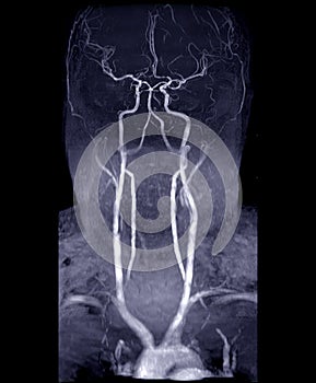 MRA Brain and neck or Magnetic resonance angiography MRA of cerebral artery and common carotid artery