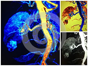 Mra lower pole renal cell carcinoma collage